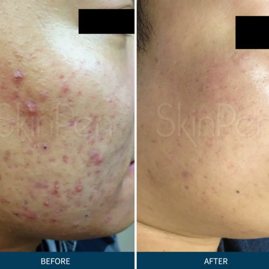 SkinPen® Microneedling