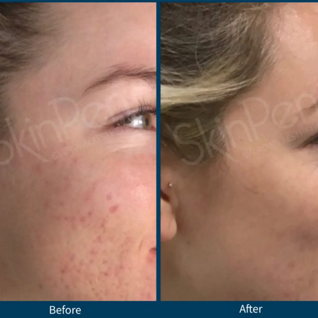 SkinPen® Microneedling